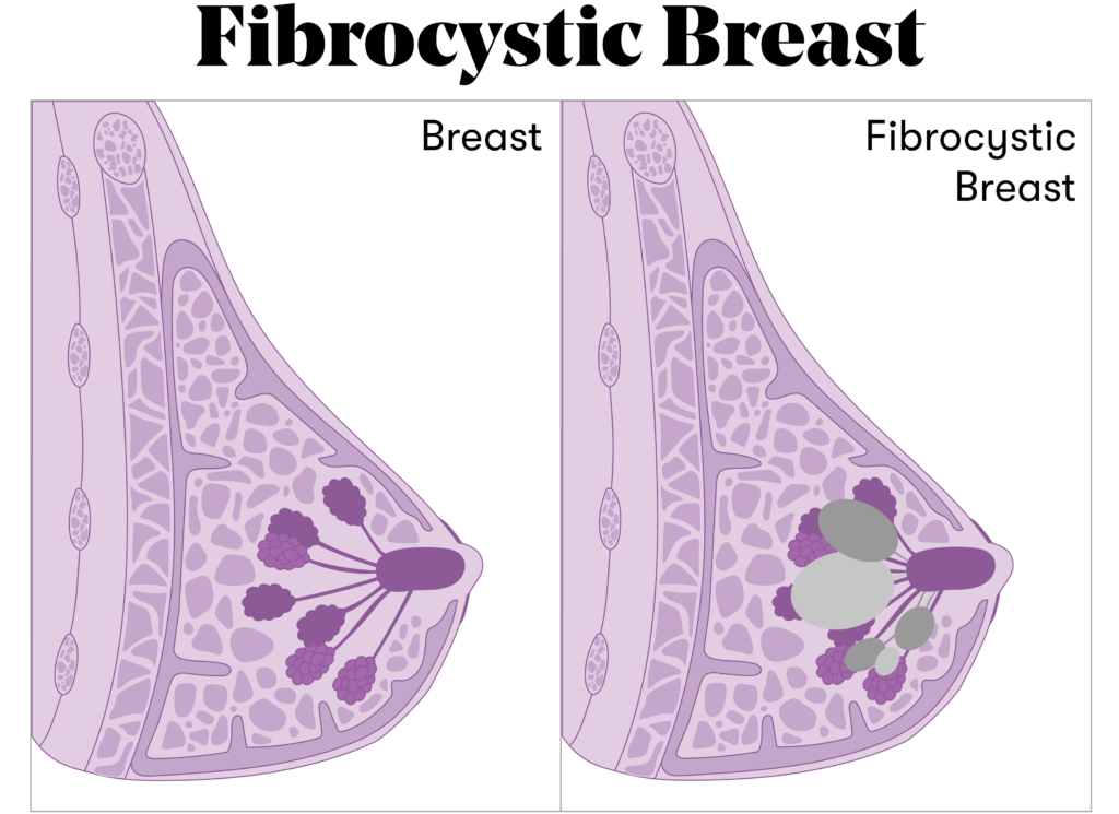 Fibrocystic Breasts